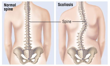 Scoliosis maksud