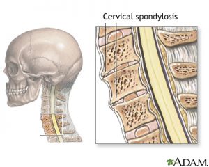 pengenalan cervical spondylosis