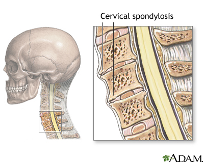 pengenalan cervical spondylosis