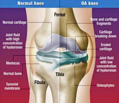 diagnosis radang sendi lutut