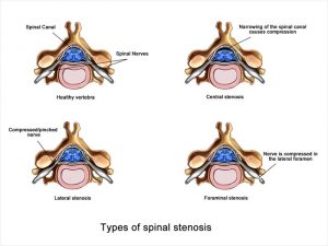 jenis stenosis tulang belakang