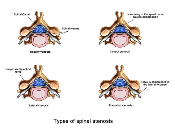 jenis stenosis tulang belakang
