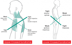 upper crossed syndrome