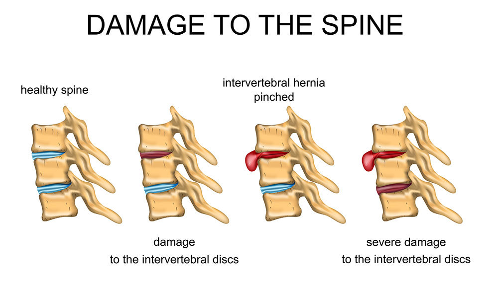 sakit tulang belakang