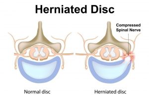 slipped disc contoh